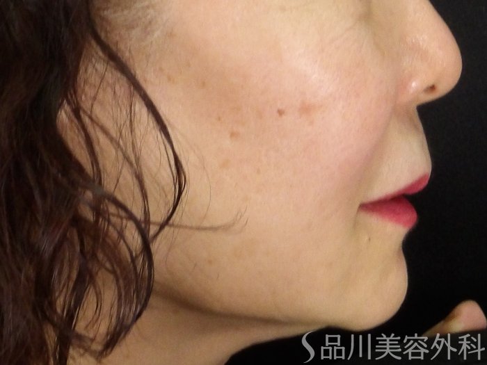 症例NO.70746のBEFORE写真
