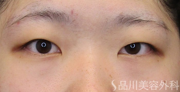 症例NO.75033のBEFORE写真