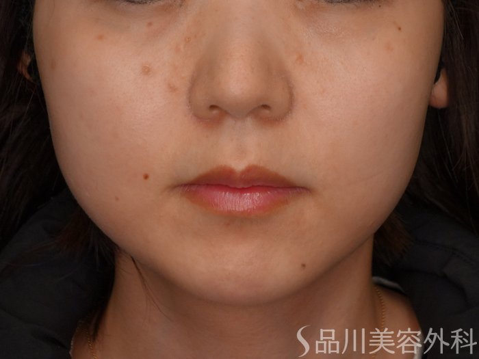 症例NO.75195のBEFORE写真