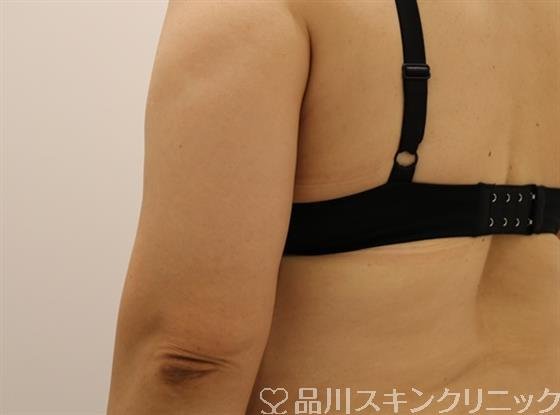 症例NO.43794のAFTER写真