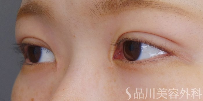 症例NO.70682のAFTER写真