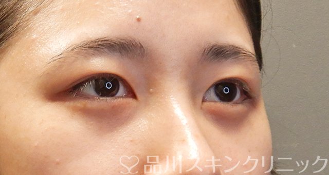 症例NO.75057のAFTER写真
