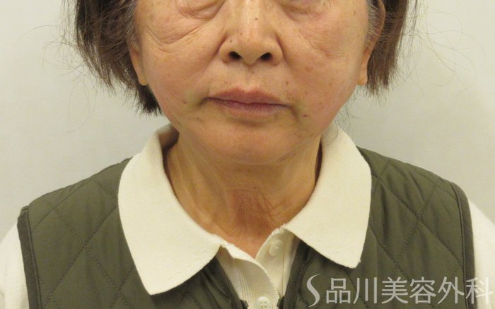 症例NO.72831のAFTER写真