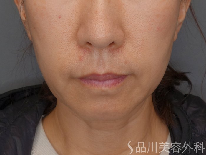 症例NO.72423のBEFORE写真