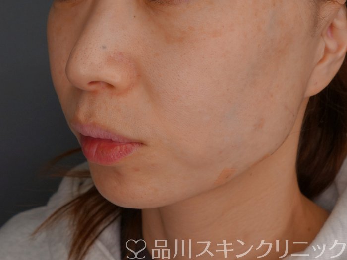 症例NO.74439のAFTER写真