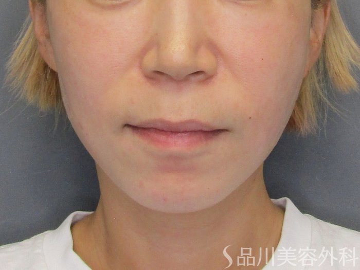 症例NO.75022のAFTER写真