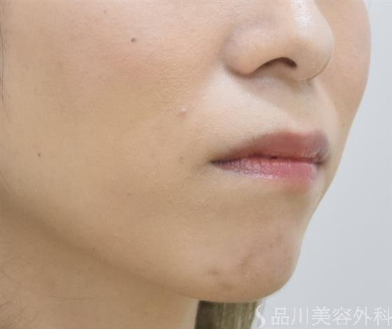 症例NO.42878のBEFORE写真