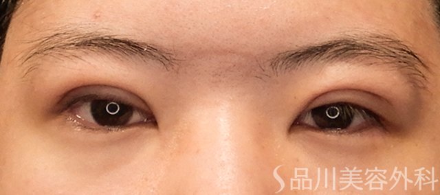 症例NO.72319のAFTER写真