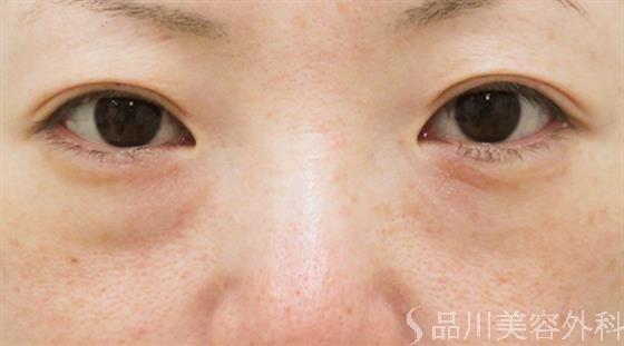 症例NO.22977のBEFORE写真