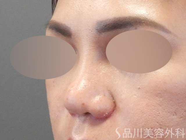 症例NO.67917のAFTER写真