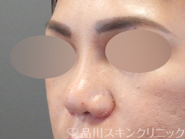 症例NO.67917のAFTER写真