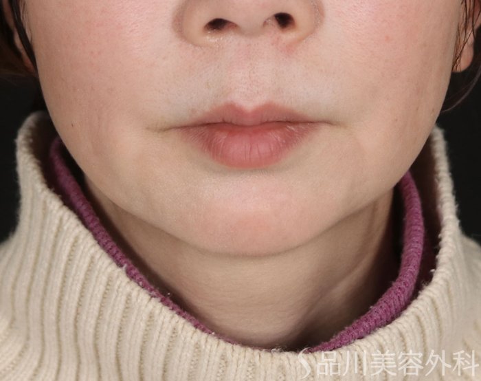 症例NO.72464のBEFORE写真