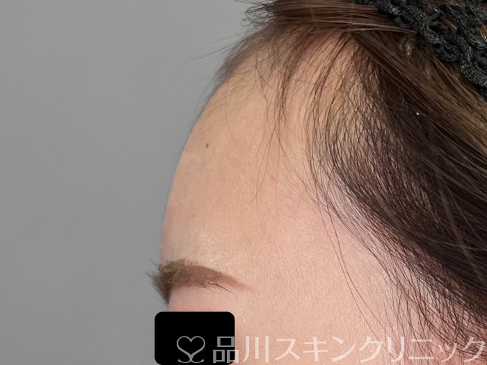 症例NO.70075のAFTER写真