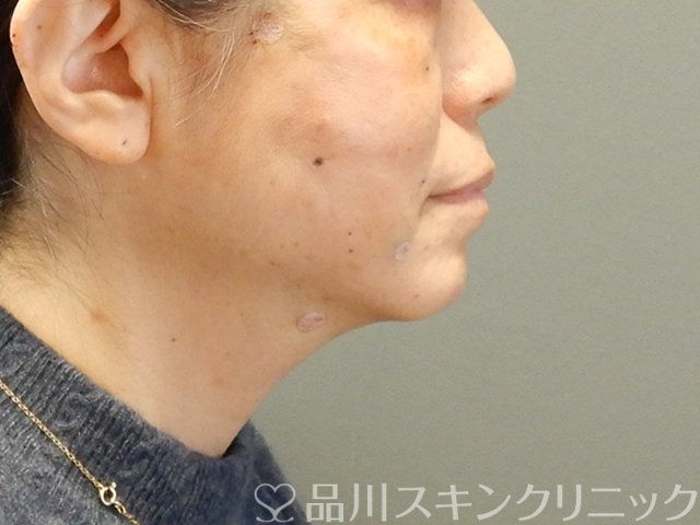 症例NO.63063のAFTER写真