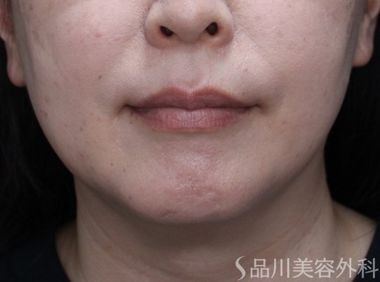 症例NO.71538のAFTER写真