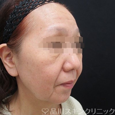 症例NO.67721のBEFORE写真