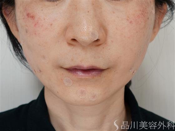 症例NO.34641のAFTER写真