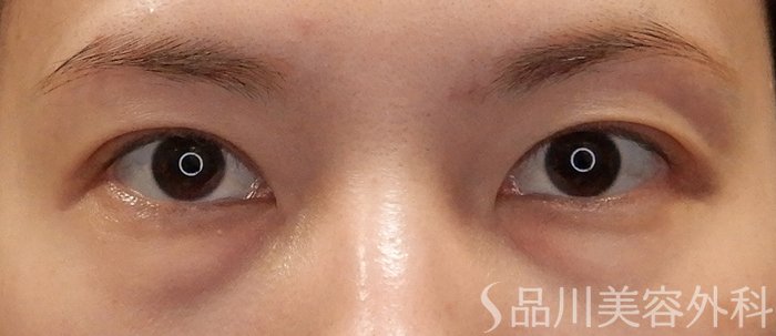 症例NO.71728のBEFORE写真