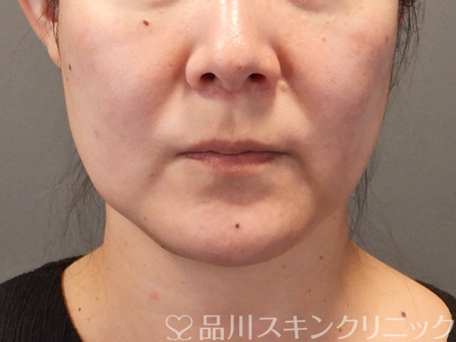症例NO.75317のBEFORE写真