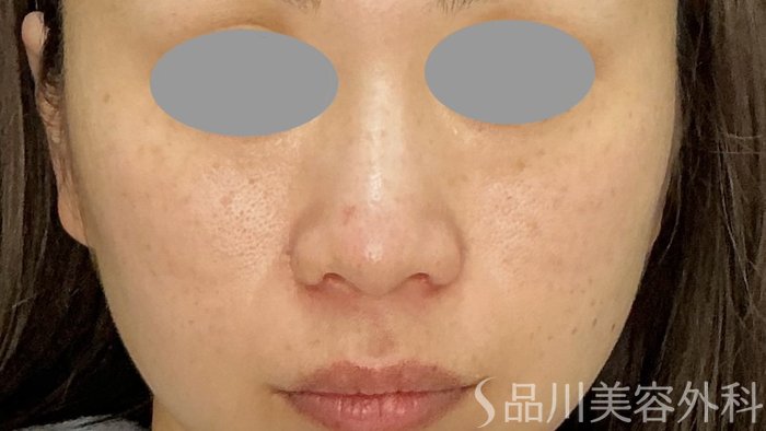症例NO.74380のAFTER写真
