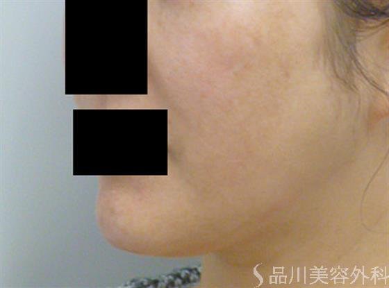 症例NO.22764のAFTER写真