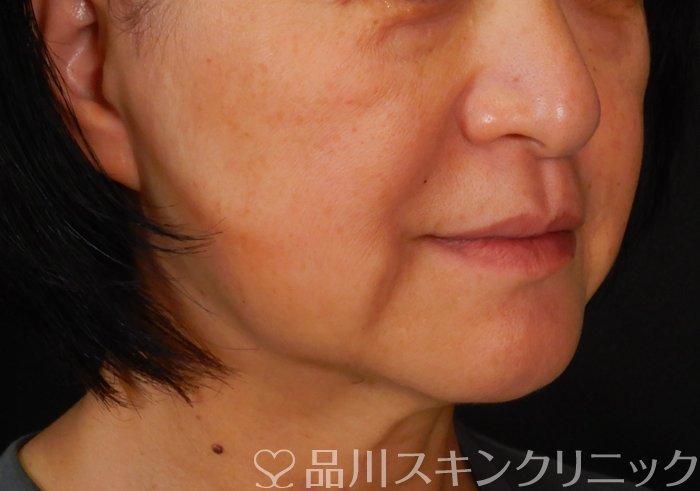 症例NO.66579のBEFORE写真