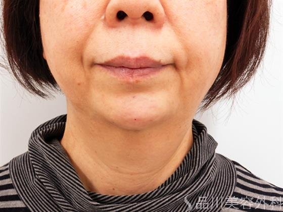 症例NO.53342のAFTER写真