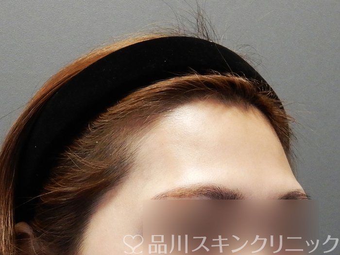 症例NO.73207のBEFORE写真