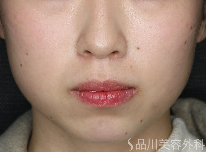 症例NO.69389のBEFORE写真