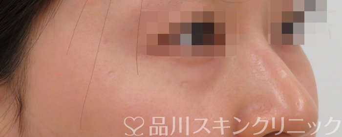 症例NO.63023のBEFORE写真