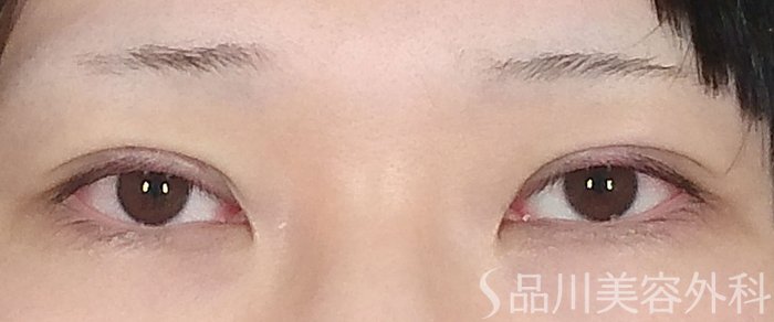 症例NO.65550のAFTER写真