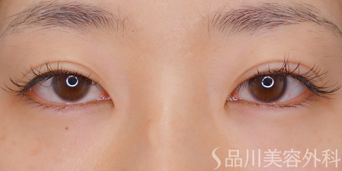 症例NO.70555のBEFORE写真