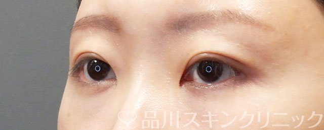 症例NO.73381のAFTER写真