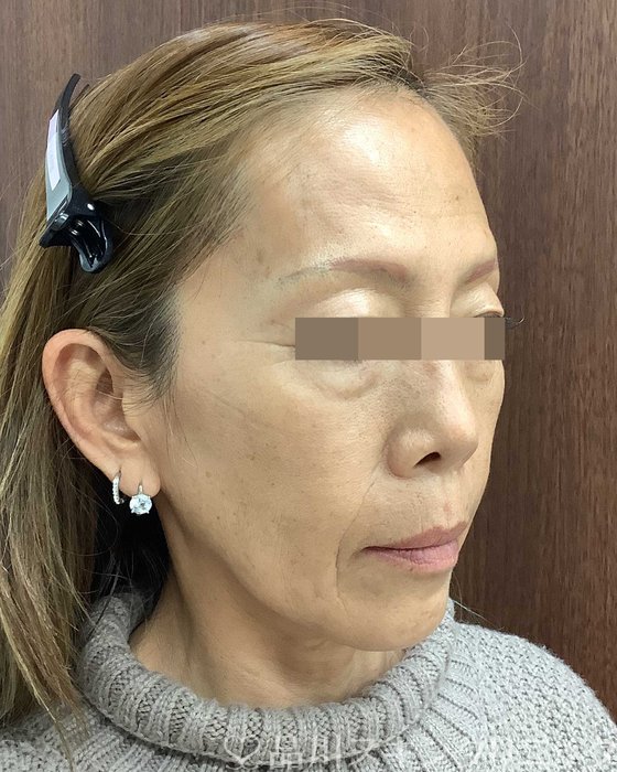 症例NO.69616のBEFORE写真