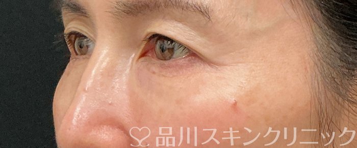 症例NO.74861のBEFORE写真