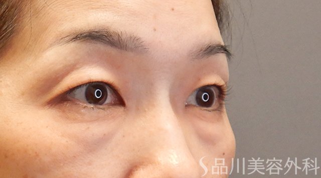 症例NO.75014のBEFORE写真