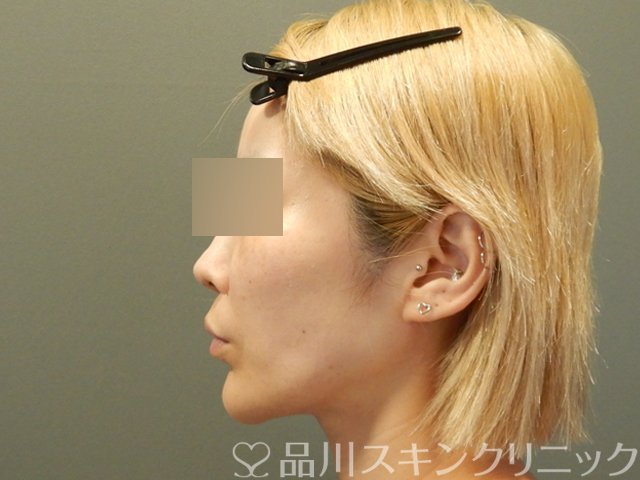症例NO.65754のBEFORE写真
