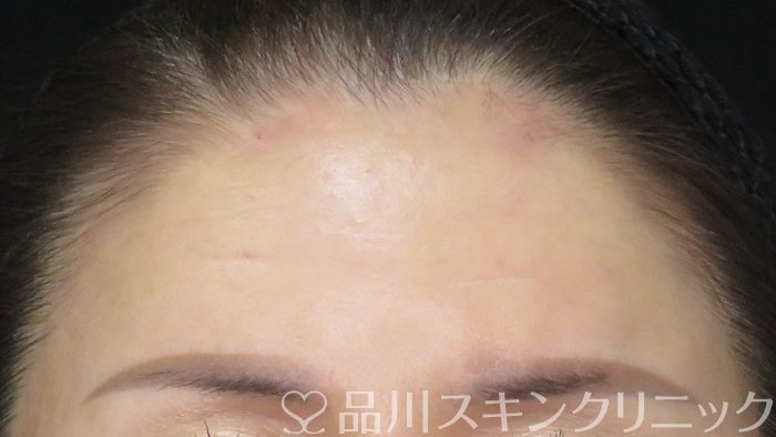 症例NO.70773のAFTER写真