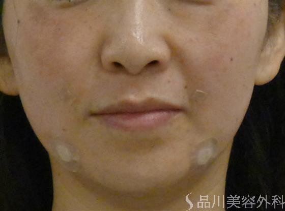 症例NO.38060のAFTER写真