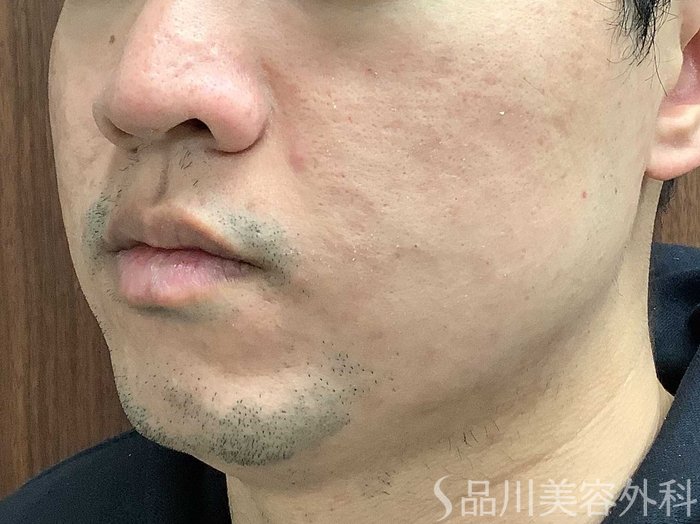 症例NO.62317のBEFORE写真