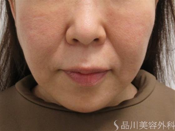 症例NO.46904のBEFORE写真
