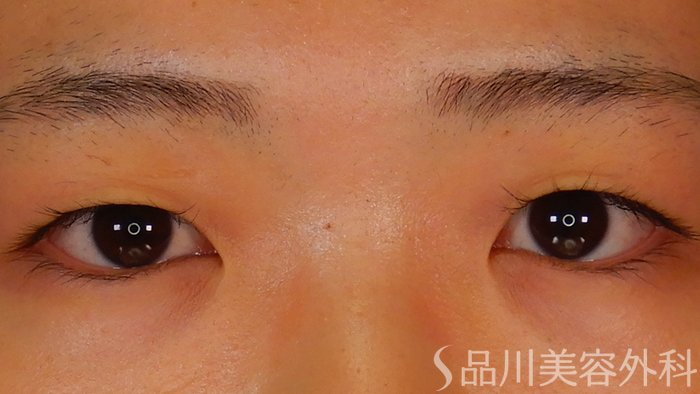 症例NO.67113のBEFORE写真