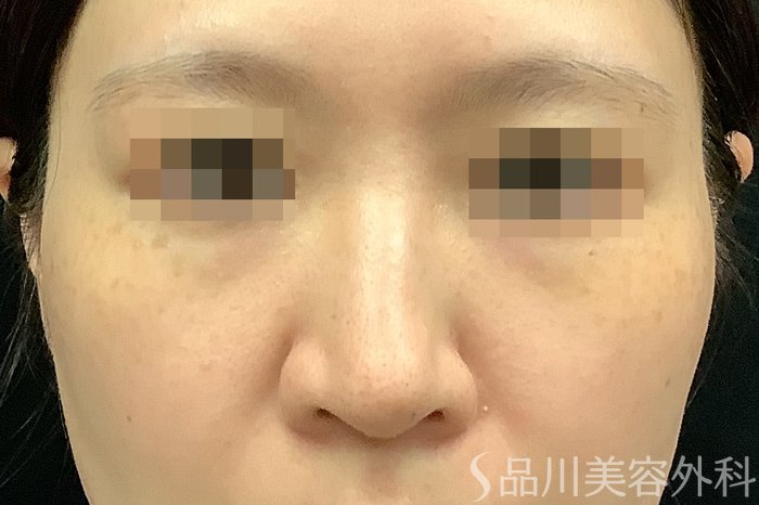 症例NO.71249のBEFORE写真