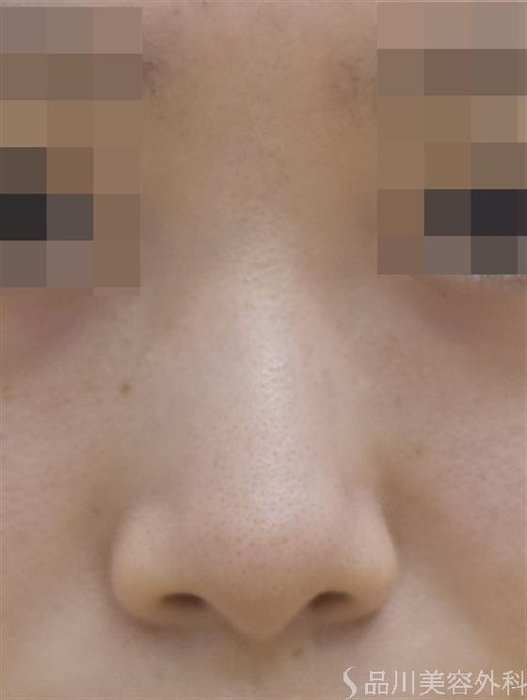 症例NO.44619のBEFORE写真