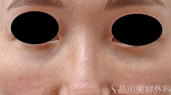 症例NO.60451のAFTER写真