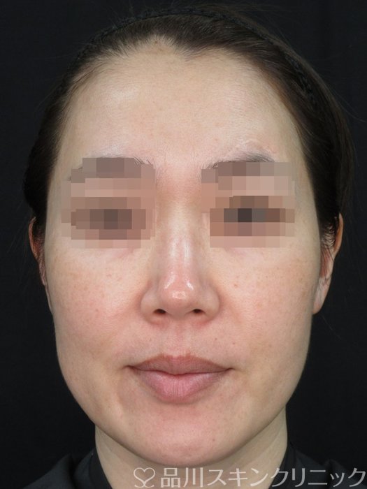 症例NO.73486のBEFORE写真