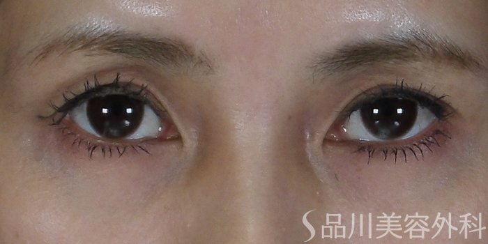 症例NO.70690のBEFORE写真