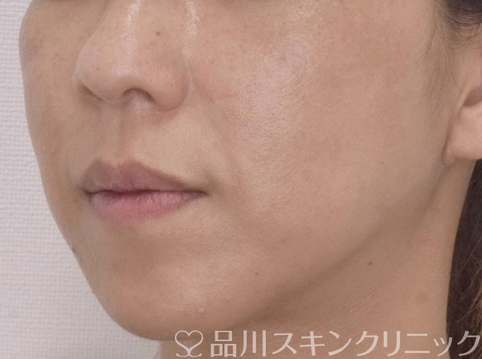 症例NO.72314のAFTER写真