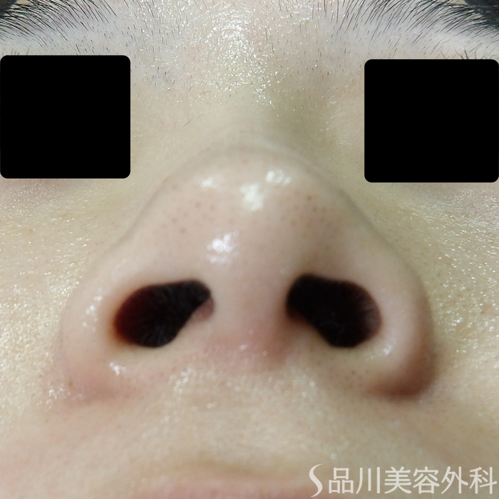 症例NO.70926のBEFORE写真