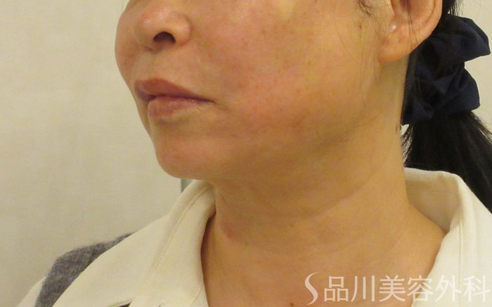 症例NO.72426のAFTER写真